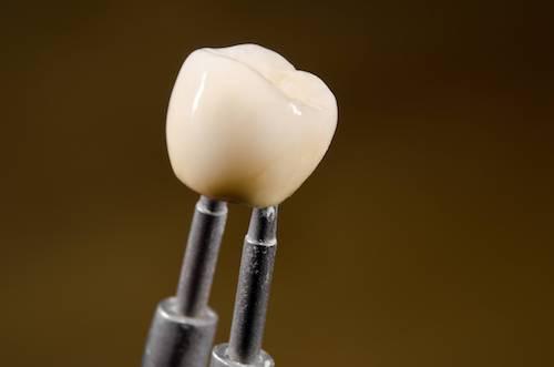 Dental Crowns and Bridges in Topeka, KS
